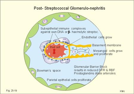 Poststreptococcal Glomerulonephritis